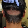 "Stealth" technique of the robotic FUE hair transplantation