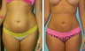 Liposuction Before & After