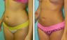 Liposuction Before & After