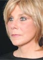 Quicklift w/neck liposuction