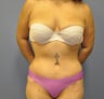 Hourglass Tummy Tuck by Dr. Wilberto Cortes