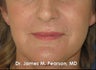 Perioral Rejuvenation