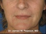 Perioral Rejuvenation