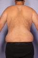 37 yr old weight loss patient