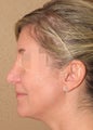 Rhinoplasty - nose job