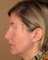 Rhinoplasty - nose job