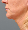 Ulthera
