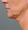 Ulthera