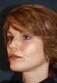 56 Year Old Female with Eyelid Surgery, Facelift and Fillers