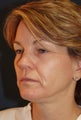 56 Year Old Female with Eyelid Surgery, Facelift and Fillers