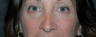 Eye Bags Treatment: Using your own fat to fill in the under eye hollows