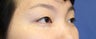 Double Eyelid Asian Blepharoplasty