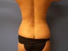Back / flank / hip liposculpture