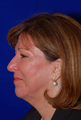 Chin Implant