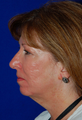 Chin Implant