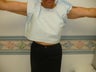 Arm lift after massive weight loss
