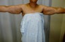 Arm lift after massive weight loss