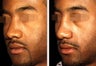 Male Patient, Rhinoplasty