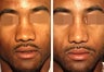 Male Patient, Rhinoplasty