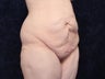 31 Year Old woman After Massive Weight Loss