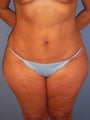 Tummy Tuck