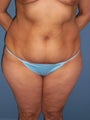 Tummy Tuck