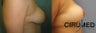 Vertical scar mastopexy