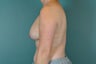 Breast Lift