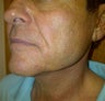 Mini Lifts are a good option for Men who want subtle & natural results