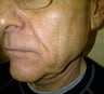 Mini Lifts are a good option for Men who want subtle & natural results