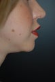 Chin Augmentation