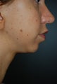 Chin Augmentation