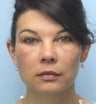 Facial Dermafillers