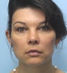 Facial Dermafillers