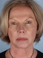 Chin Implant