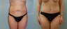 Mommy Makeover: 33-Year-Old
