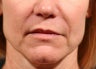 Juvederm Ultra XC to nasolabial folds