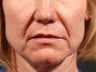 Juvederm Ultra XC to nasolabial folds