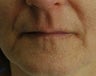 direct lip lift
