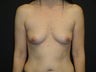 Implant-based breast reconstruction