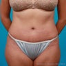 Revisional Abdominoplasty