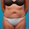 Revisional Abdominoplasty