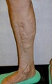 Endovenous Laser Ablation, EVLT, Before and After