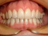 Crowded teeth treated with Invisalign