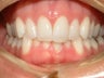 Crowded teeth treated with Invisalign
