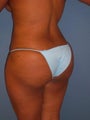 Brazilian Butt Lift