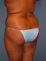 Brazilian Butt Lift