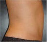SmartLipo