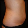 SmartLipo