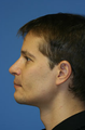 Jaw/Mandible Implant